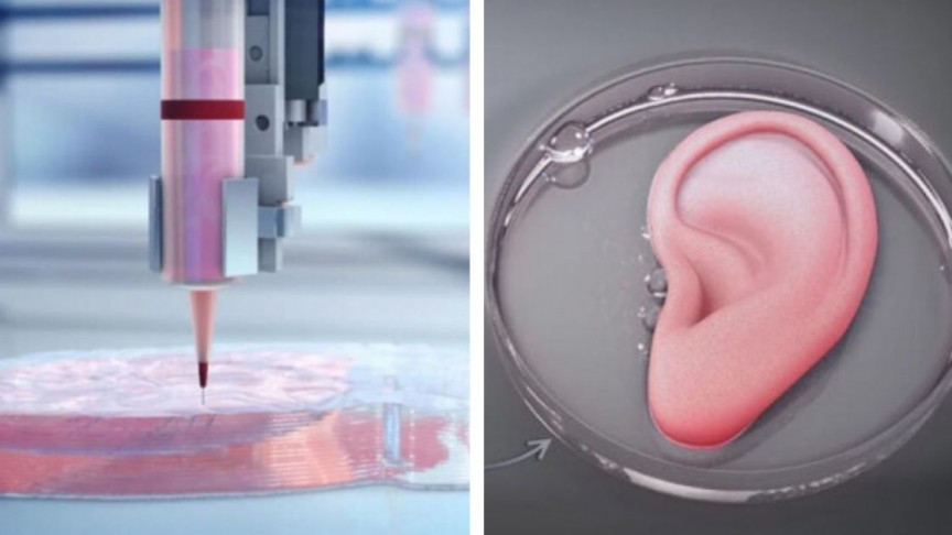 Por primera vez trasplantaron una oreja impresa en 3D con células humanas