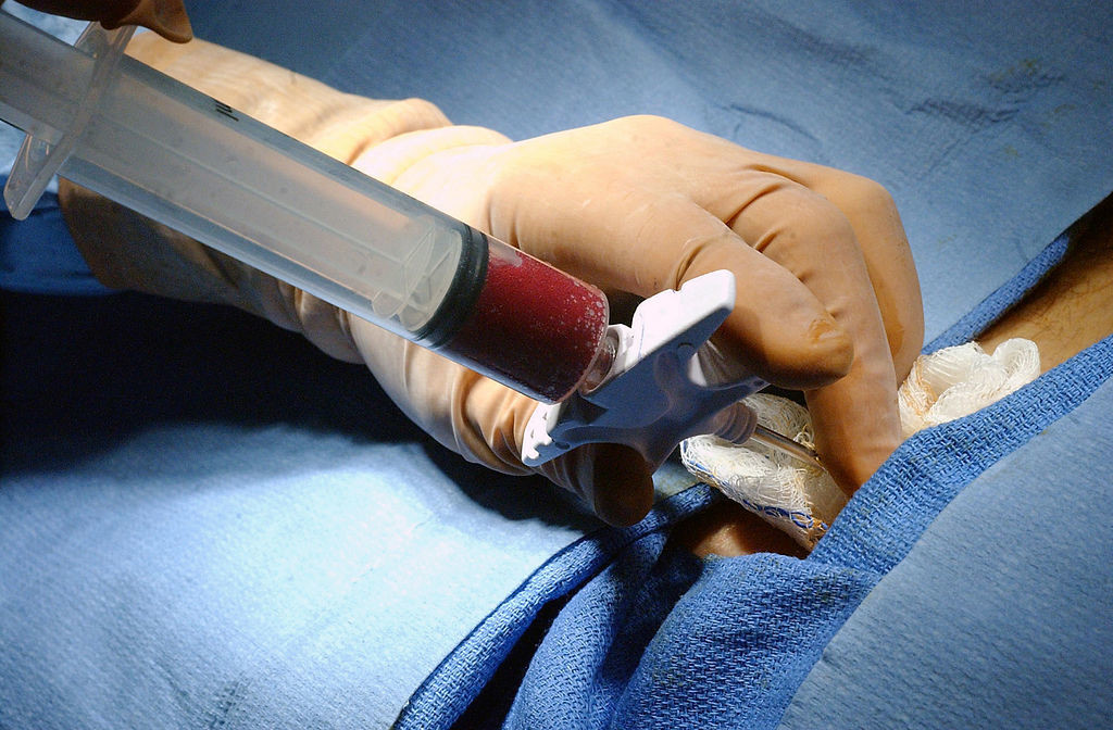 Clínica neuquina realizó 50 trasplantes de médula ósea